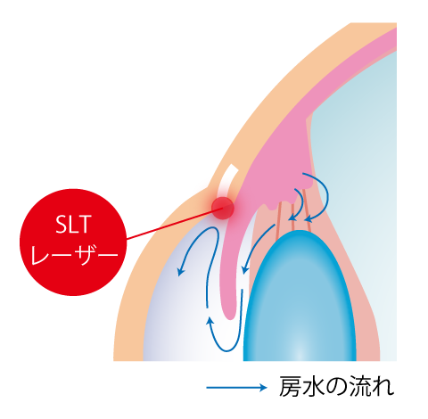 緑内障レーザーSLT選択的レーザー線維柱帯形成術武蔵浦和 さいたま市の眼科あしかわ眼科